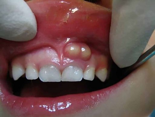 Áp xe răng là một dạng nhiễm trùng gây ra bởi sâu răng, nứt răng,...
