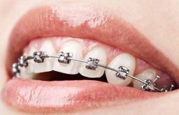 Niềng răng mắc cài tự đóng là bước cải tiến mới trong ngành nha khoa
