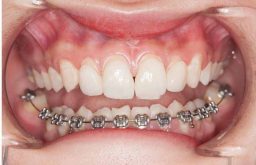 Niềng răng 1 hàm bằng mắc cài kim loại