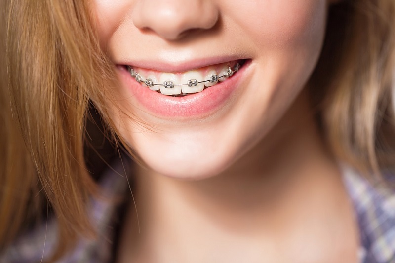Dây cung niềng răng là một loại khí cụ quan trọng trong phương pháp niềng răng có mắc cài