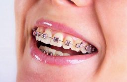 Có các loại dây cung niềng răng nào? Tác dụng cụ thể