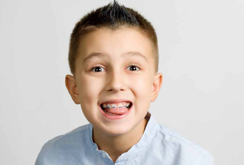 Độ tuổi thích hợp niềng răng là khi trẻ ở khoảng 10 - 16 tuổi