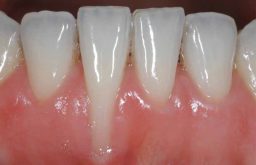 Niềng răng bị tụt lợi là tình trạng phổ biến khi chỉnh nha