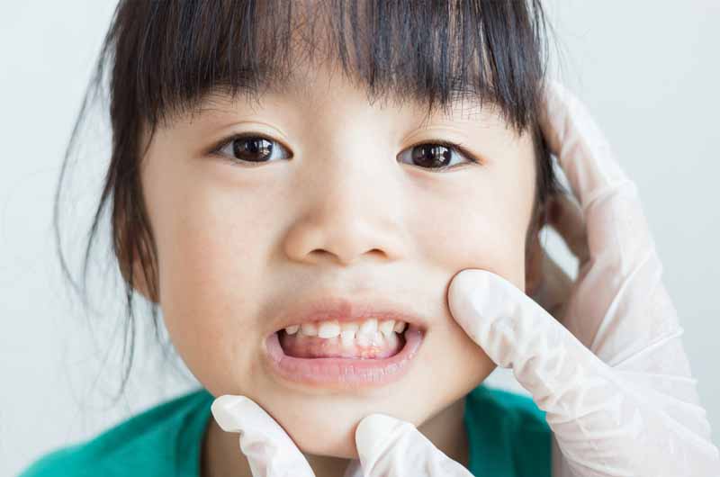 Niềng răng cho trẻ là gì?