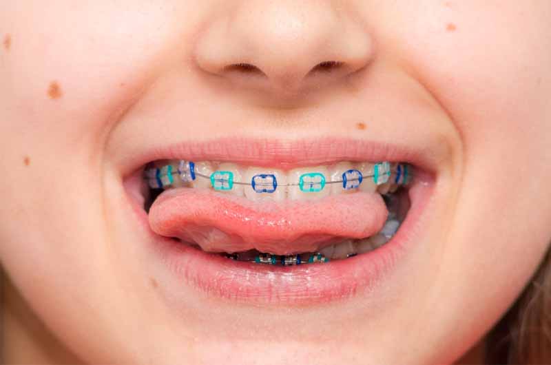 Niềng răng bằng mắc cài cố định mang lại hiệu quả chỉnh nha cao cho trẻ