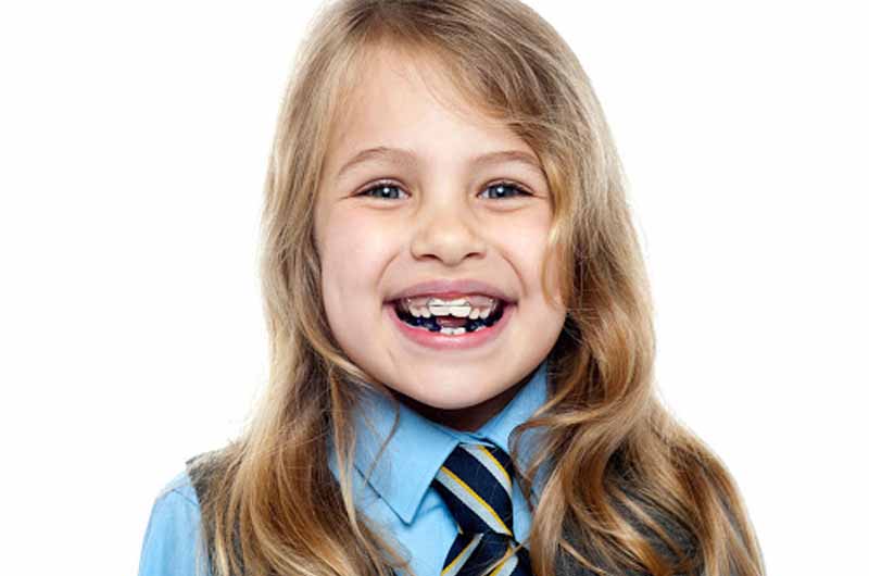 Độ tuổi cũng là yếu tố ảnh hưởng nhiều đến kết quả niềng răng hô