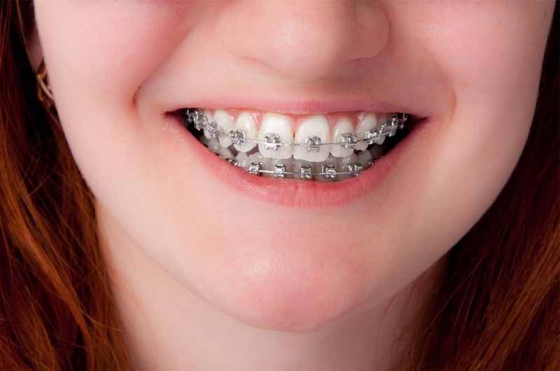 Phương pháp niềng răng hô bàng mắc cài kim loại thông thường
