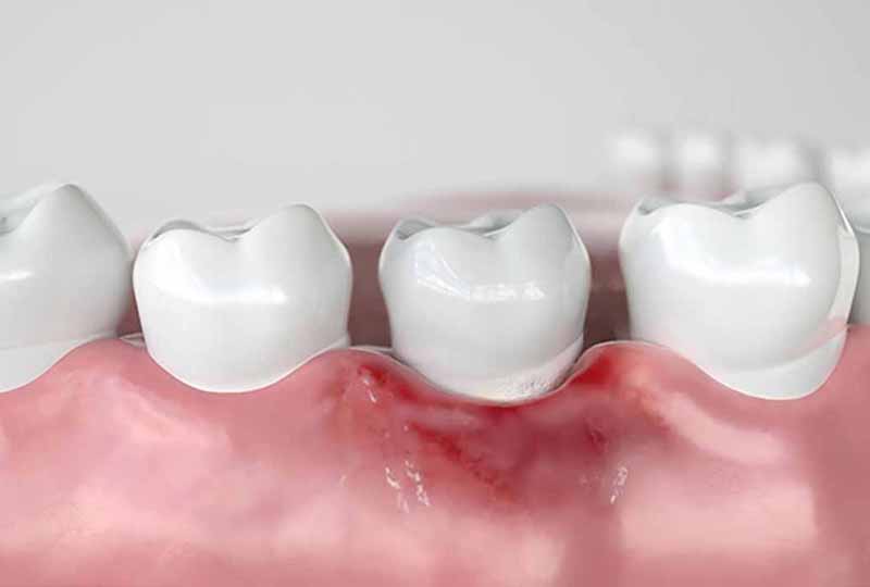 Khớp cắn sâu kéo dài có thể gây ra các bệnh lý về răng miệng