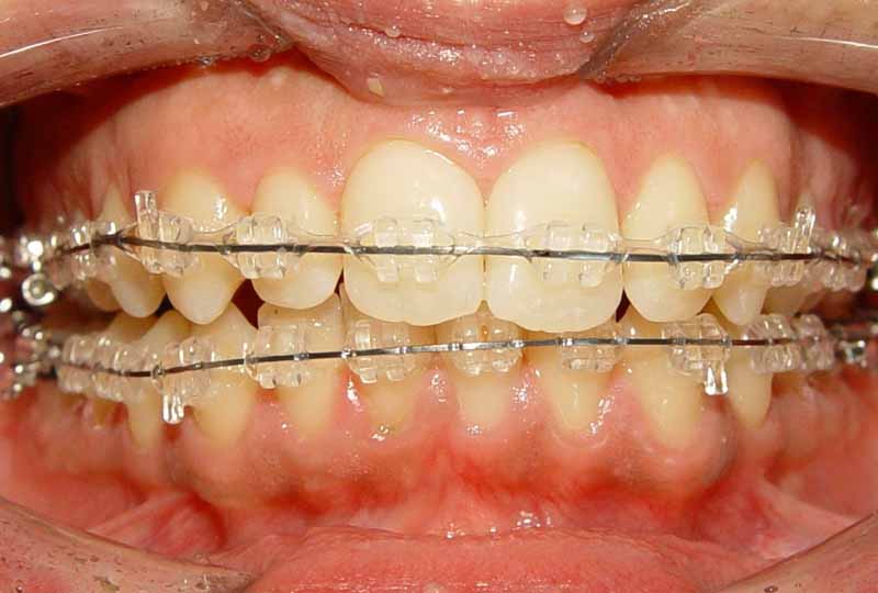 Phương pháp niềng răng mắc cài sứ