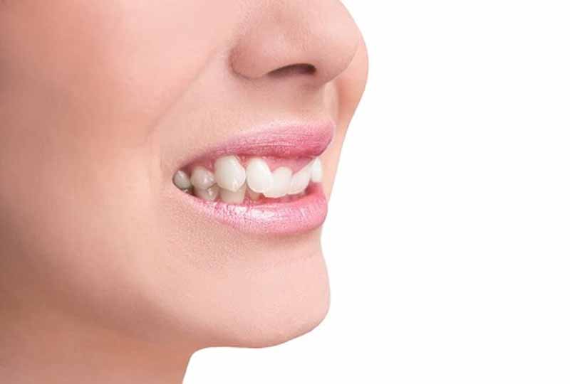 Việc nhổ răng khi niềng sẽ phụ thuộc vào hàm răng thực tế của người bệnh