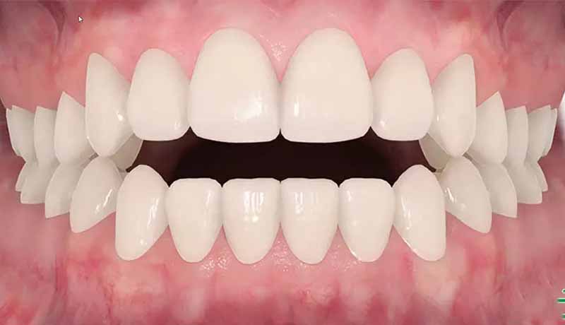 Thời gian niềng răng phụ thuộc vào nhiều yếu tố
