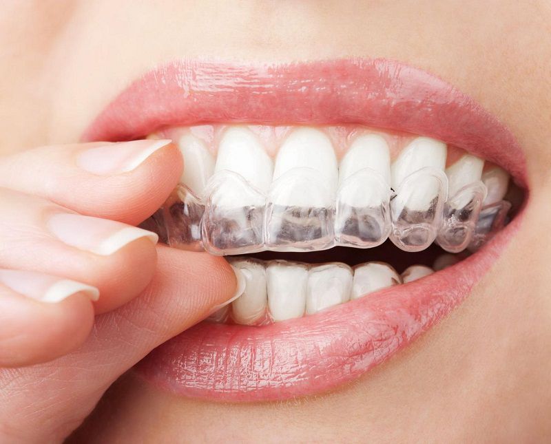 Quy trình niềng răng được thực hiện một cách nghiêm chỉnh sẽ giúp đẩy nhanh hiệu quả chỉnh nha
