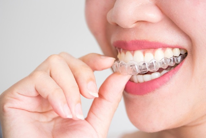 giá thành của niềng răng trong suốt leetray sẽ dao động trong khoảng từ 60 - 120 triệu/ca