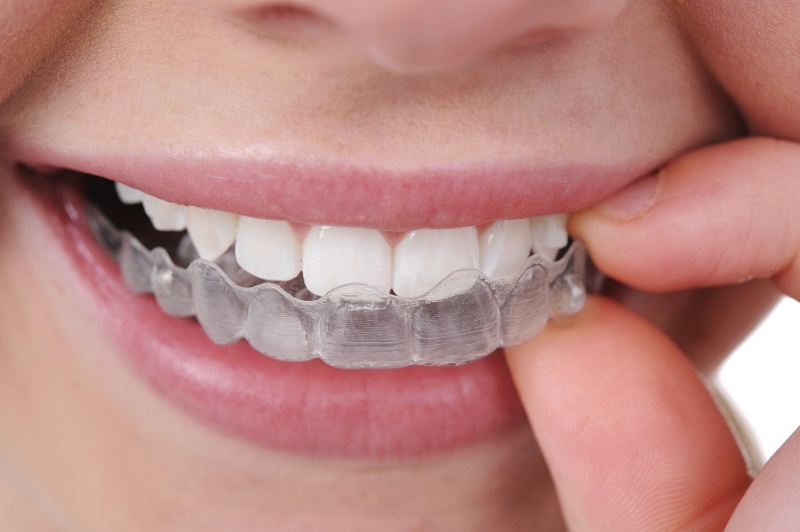 Niềng răng leetray là phương pháp chỉnh nha mới giúp căn chỉnh lại vị trí của những chiếc răng mọc lệch trên cung hàm