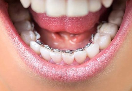 Niềng răng mắc cài mặt trong là phương pháp chỉnh nha được ưa chuộng hiện nay