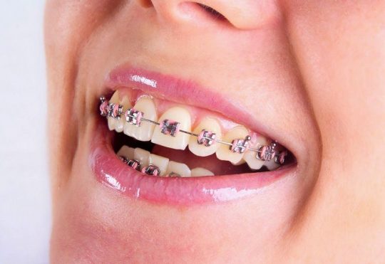Niềng răng sắt là phương pháp gì? Thời gian và chi phí thực hiện