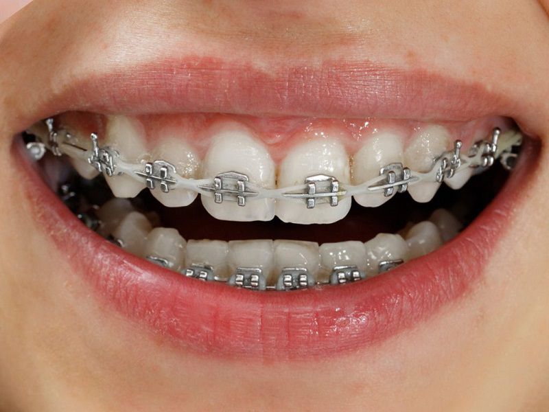Niềng răng sắt là phương pháp niềng răng truyền thông