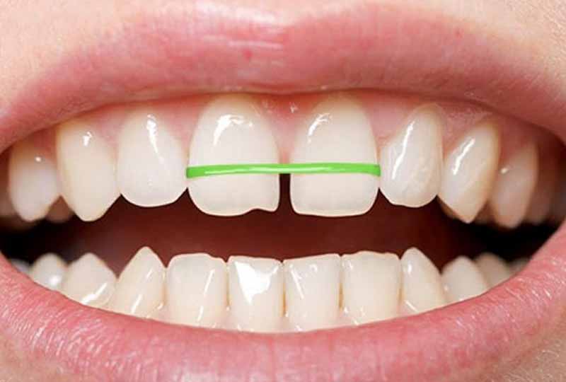 Niềng răng bằng dây thun tự chế có thể gây nguy hiểm đến hàm răng