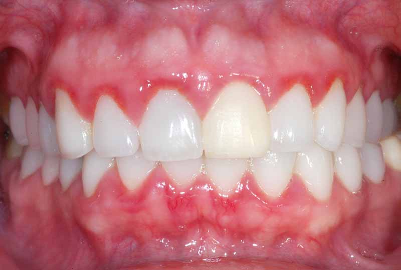Việc niềng răng cho trẻ tại nhà có thể gây ra các bệnh lý về răng miệng