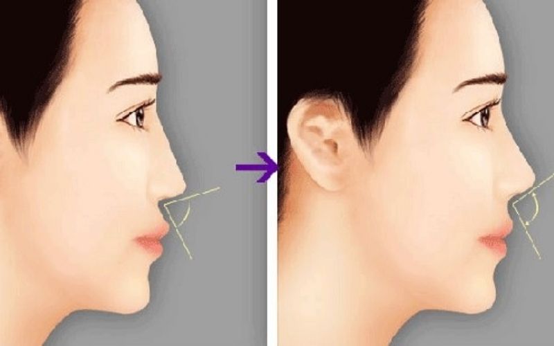 Niềng răng hô trước và sau dễ dàng nhận thấy sự khác biệt về góc mũi