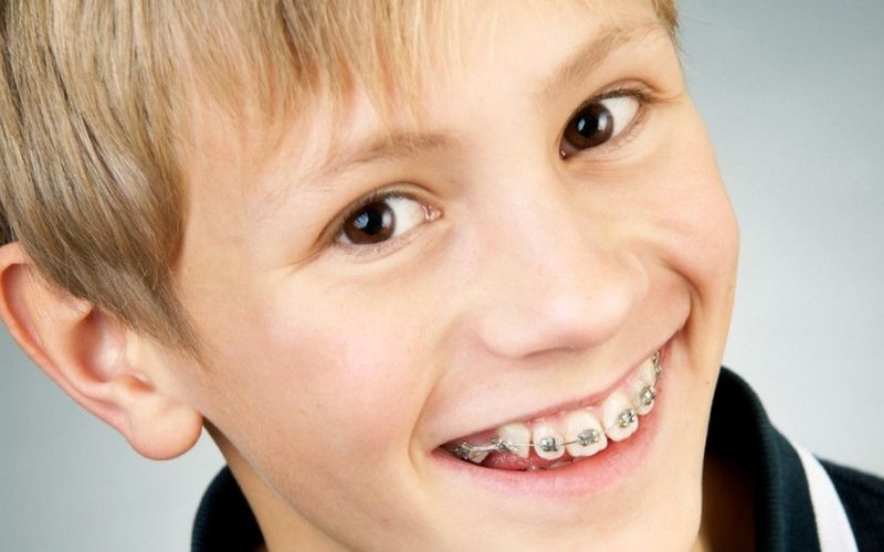 Khí cụ chỉnh nha quyết định phần lớn đến hiệu quả niềng răng