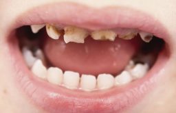 Sún răng là hiện tượng rất thường thấy ở trẻ 1 - 3 tuổi