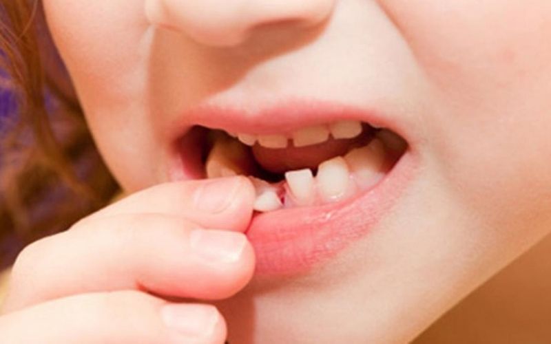 Sún răng khiến quá trình thay thế răng bị ảnh hưởng lớn