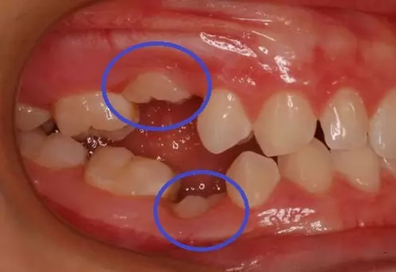 Tác hại của niềng răng khiến răng bị cứng liền khớp