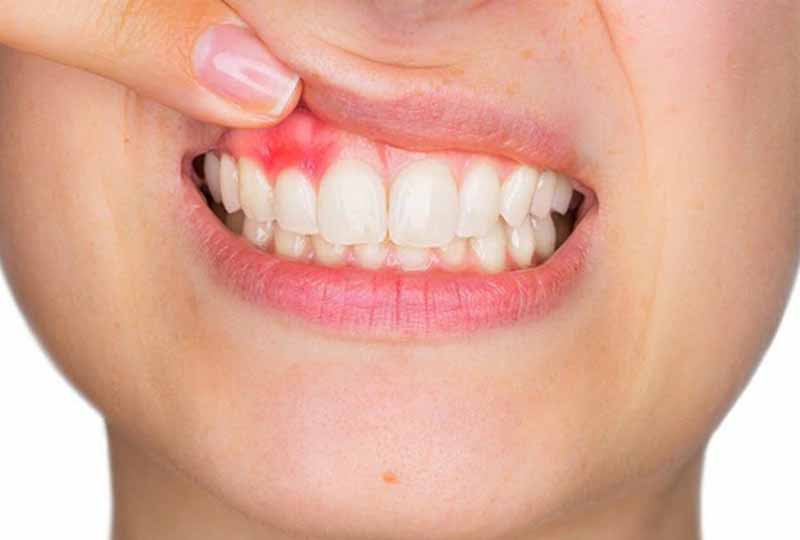Hình ảnh viêm lợi - tình trạng mảng bám trên răng gây kích ứng, sưng tấy nướu