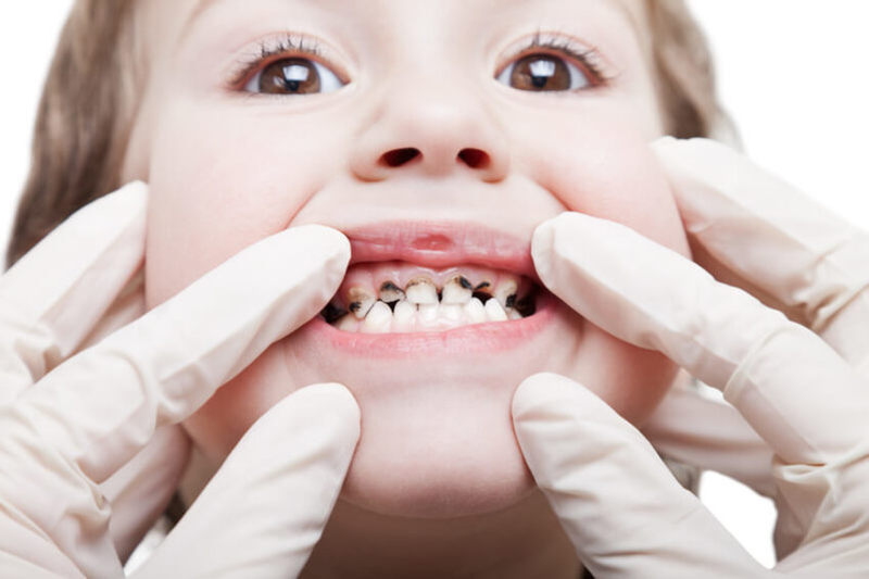 Bé bị viêm nha chu sẽ có nguy cơ mất răng vĩnh viễn nếu không được điều trị kịp thời