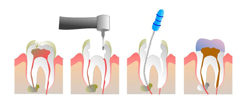 Các bước điều trị sâu răng vào tủy