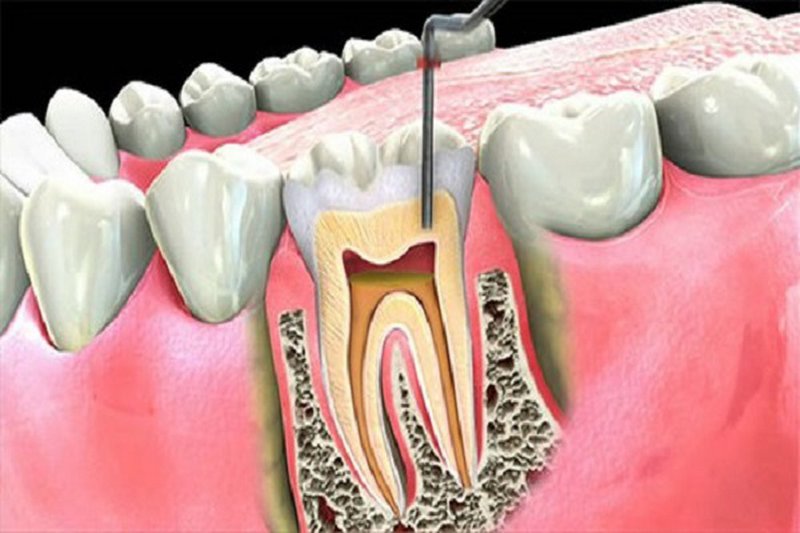Phương pháp này nhằm bảo tồn được chân răng và loại bỏ hoàn toàn nguồn gây bệnh