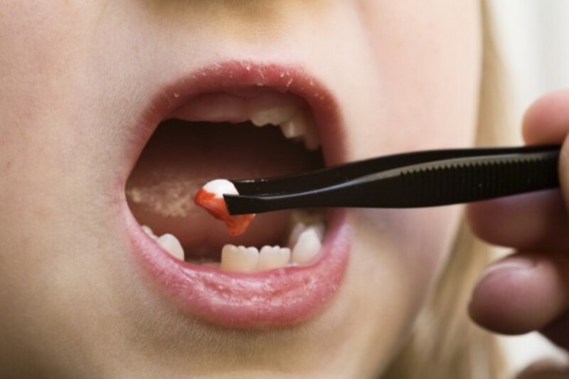 Cần lưu ý trước và sau khi nhổ răng sữa cho bé 