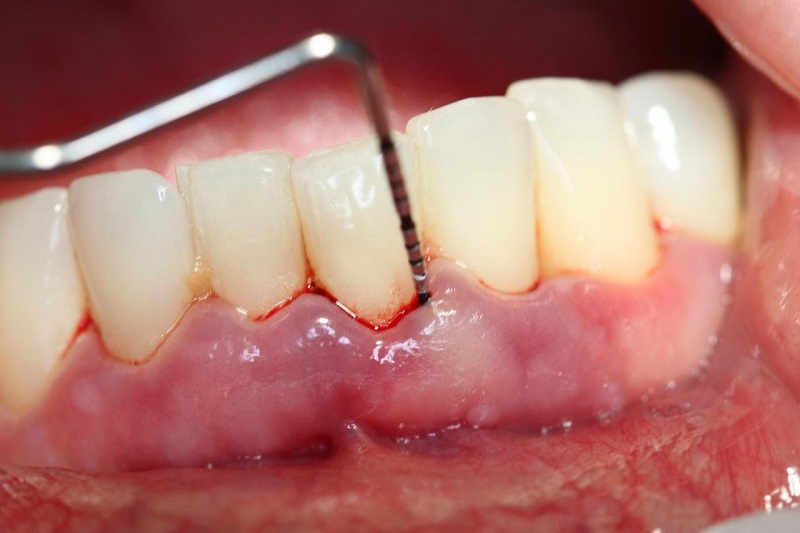 Viêm tủy, chảy máu chân răng,... là một trong những nguyên nhân gây bệnh áp xe răng