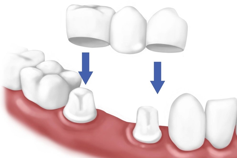 Cầu răng sứ là giải pháp khắc phục chức năng nhai khi bị mất 1 răng hoặc vài răng cạnh nhau.