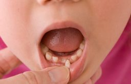 Cha mẹ cần lưu ý trước và sau khi nhổ răng sữa tại nhà cho bé