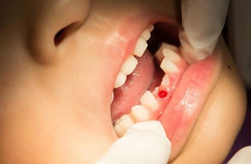 Cha mẹ nên chú ý khi các bé nhổ răng sữa sót chân răng 
