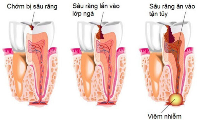 Quá trình sâu răng diễn ra trong khoảng từ 1 - 2 năm