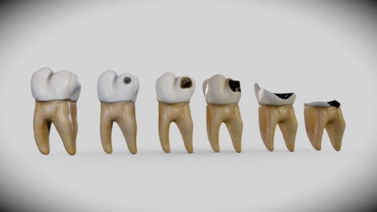 Quá trình sâu răng