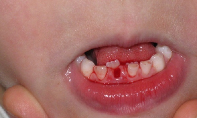 Nhổ răng không đúng cách sẽ có rất nhiều mối nguy hiểm và ảnh hưởng nghiêm trọng đến trẻ