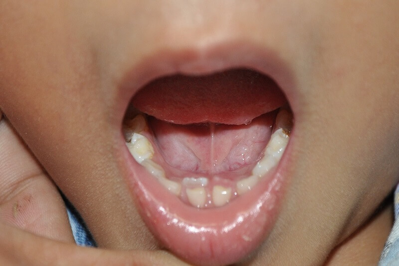Tìm hiểu răng trẻ mọc lẫy là thế nào