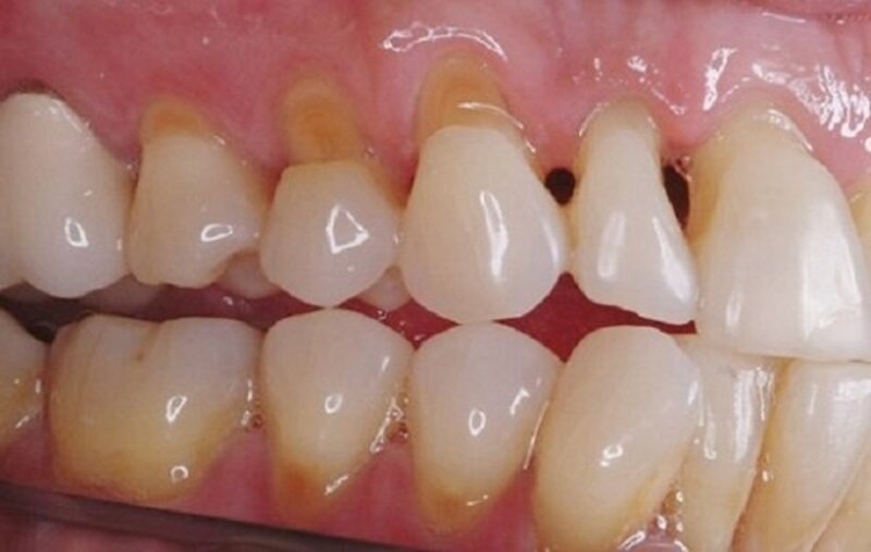 Đây là một trong những tình trạng sâu răng thông thường