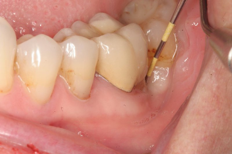 Người bị sâu khe răng thường gặp cản trở trong quá trình ăn uống hàng