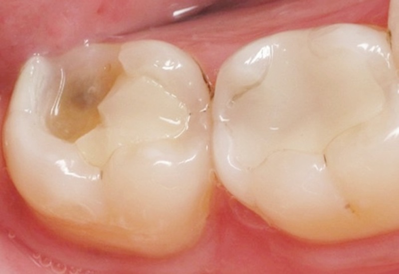 Nguyên nhân gây sâu răng hàm dưới trong cùng là việc người bệnh sử dụng phương pháp trám răng