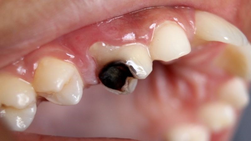 Sâu răng xuất hiện hạch ở cổ khiến người bệnh đau nhức, khó chịu