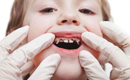 Sâu răng trẻ em - Nguyên nhân, Biểu hiện và cách điều trị