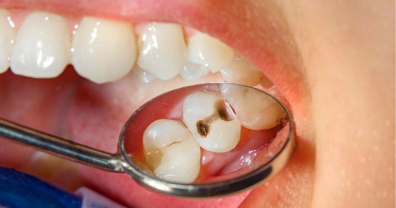 Trị sâu răng cho bé bằng phương pháp trám răng được chỉ định khi sâu răng ở mức độ nhẹ