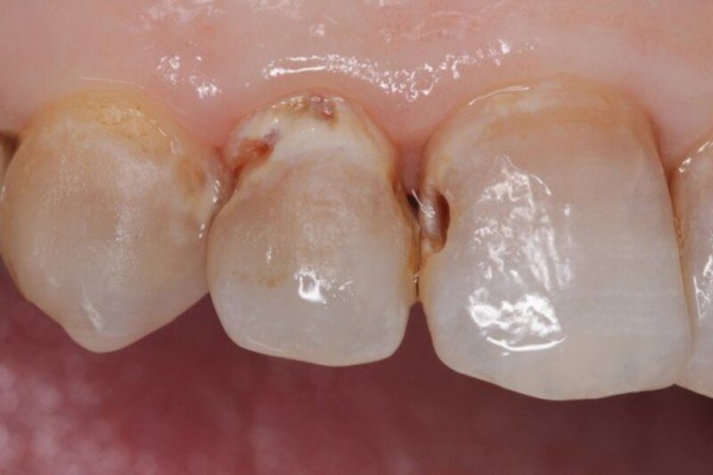 Sau khi bị sâu men răng thì đây là giai đoạn nặng hơn khi người bệnh bắt đầu tiến tới bị sâu ngà nâu