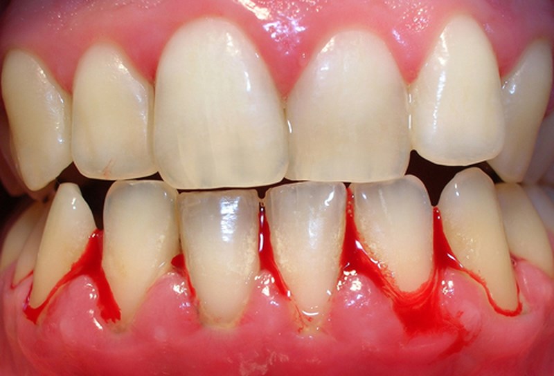 Răng dễ bị nhạy cảm và xuất hiện tình trạng chảy máu chân răng