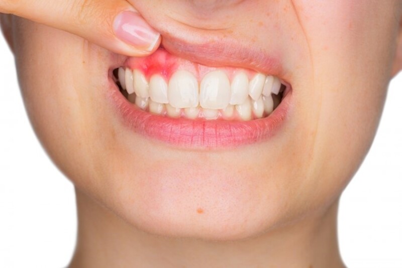 Viêm nướu chân răng là bệnh lý gây ra những ảnh hưởng nghiêm trọng đến sức khỏe răng miệng và cơ thể